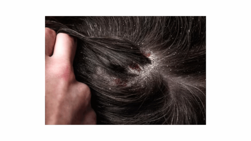 Foliculite shampoo Foliculite shampoo