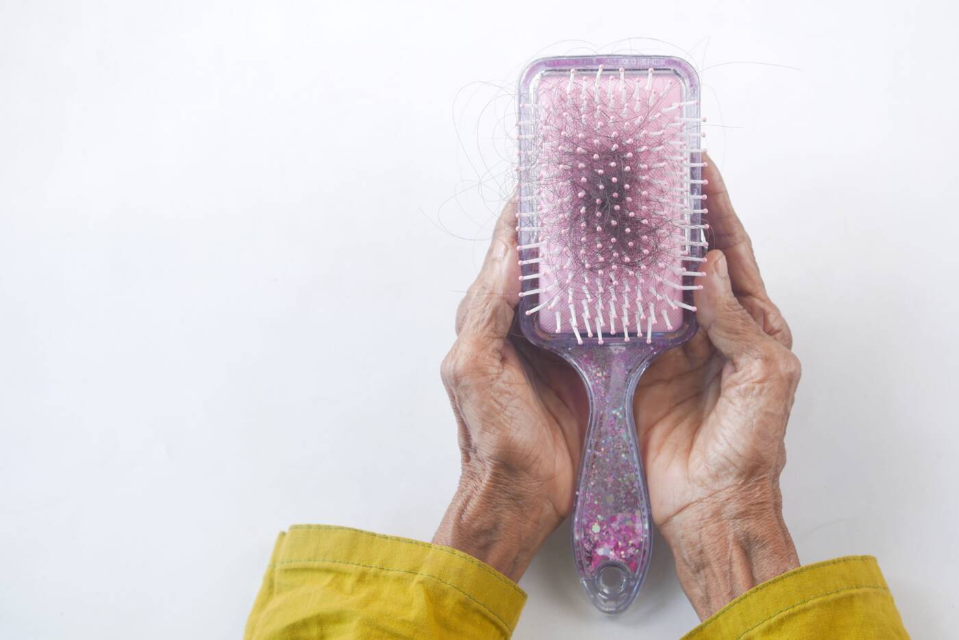 Escova com fios de cabelo, ilustrando shedding e aumento temporário da queda capilar